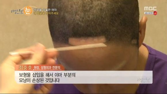 [리얼스토리눈] 15곳을 수술한 여자 내 얼굴을 찾아주세요 (성형수술 부작용) | 인스티즈