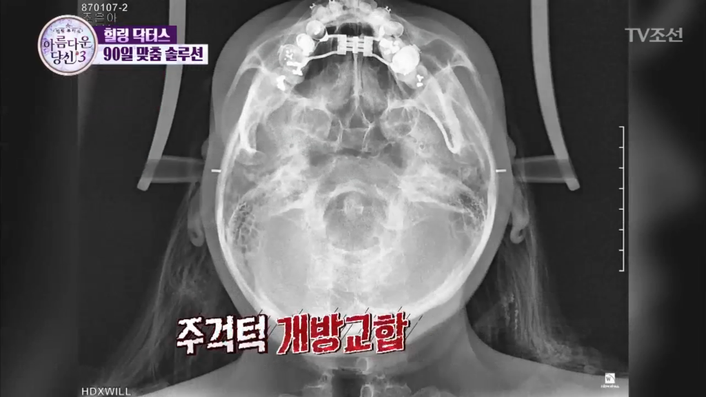 부정교합을 방치하면 안되는 이유 | 인스티즈