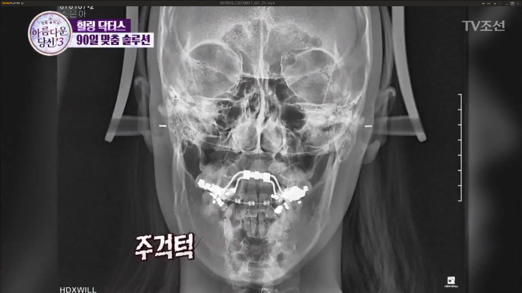 부정교합을 방치하면 안되는 이유 | 인스티즈
