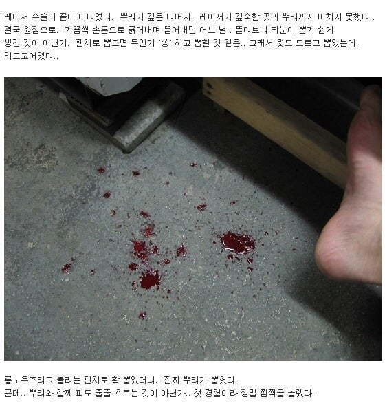 이쯤에서 생각나는 티눈뽑기 (혐오주의) | 인스티즈