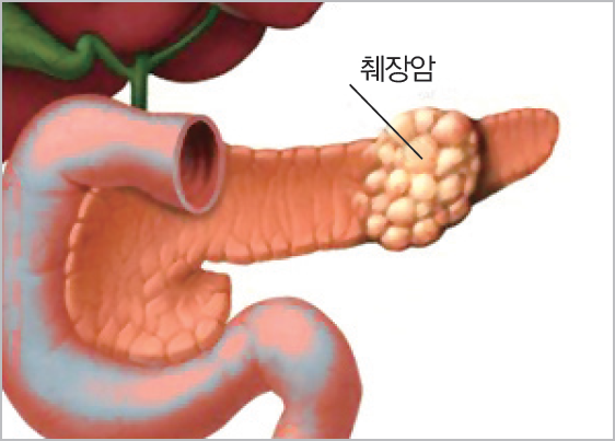 질병중에서도 끝판왕 이라는 암 | 인스티즈