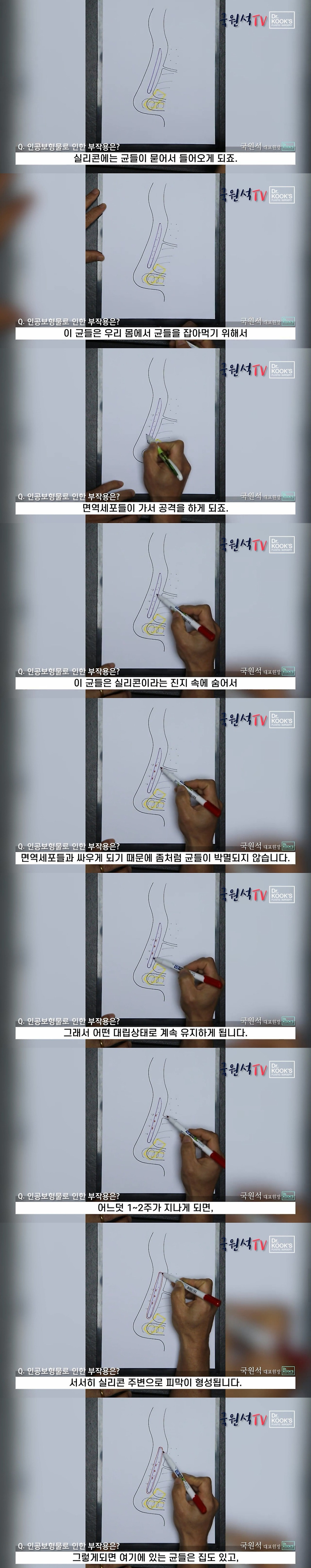 코 성형 후 구축이 생기는 과정 | 인스티즈