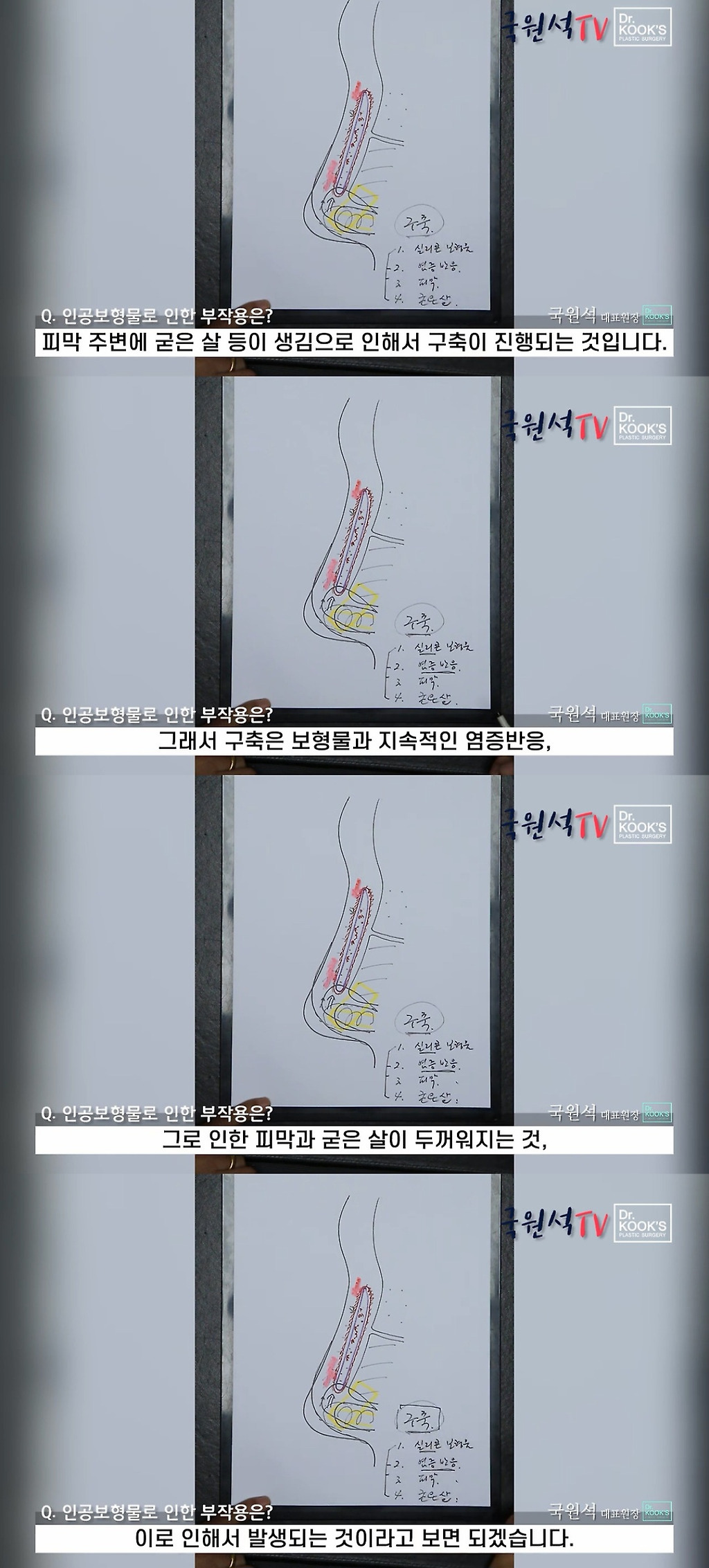 코 성형 후 구축이 생기는 과정 | 인스티즈
