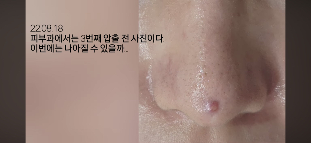 코수술 부작용으로 인한 코끝 꺼짐 + 자가진피 코수술 후기 | 인스티즈
