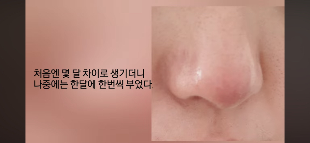 코수술 부작용으로 인한 코끝 꺼짐 + 자가진피 코수술 후기 | 인스티즈