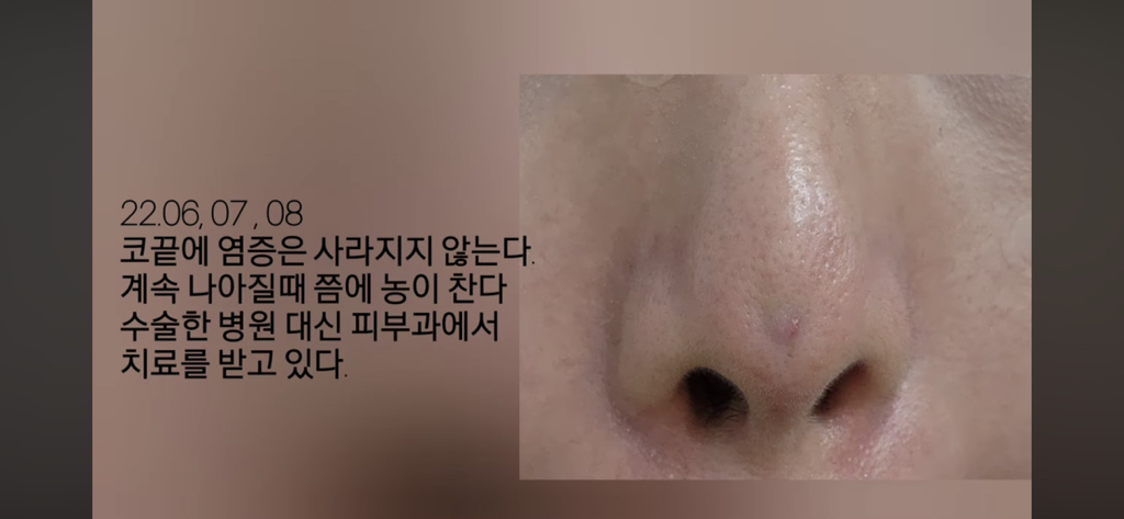 코수술 부작용으로 인한 코끝 꺼짐 + 자가진피 코수술 후기 | 인스티즈