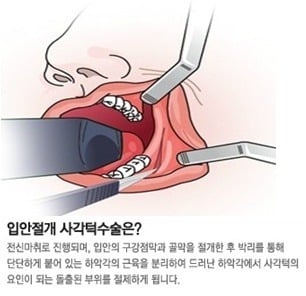 턱수술과 양악수술의 차이.gif | 인스티즈