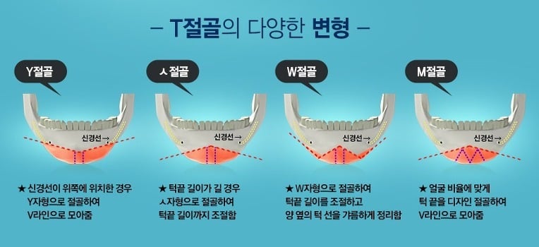 턱수술과 양악수술의 차이.gif | 인스티즈