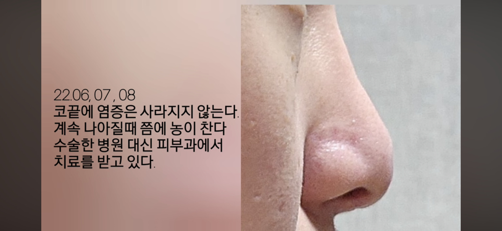 코수술 부작용으로 인한 코끝 꺼짐 + 자가진피 코수술 후기 | 인스티즈