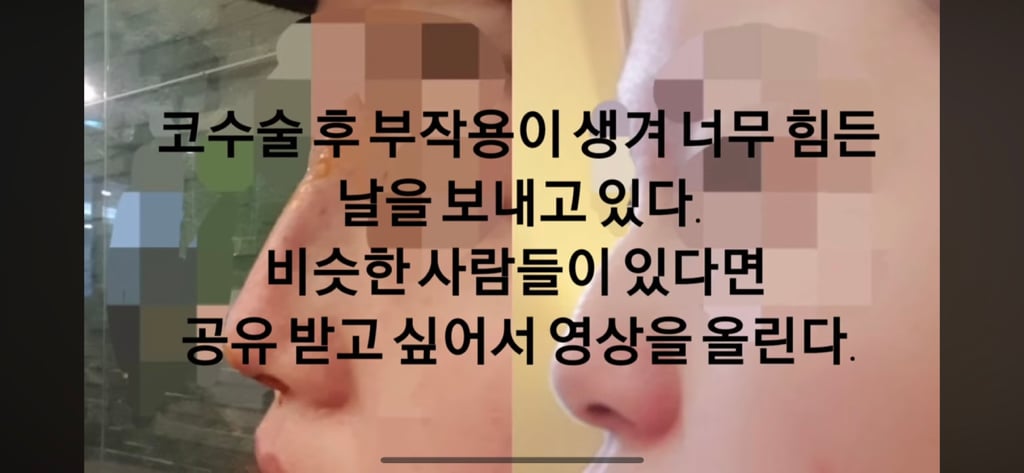 코수술 부작용으로 인한 코끝 꺼짐 + 자가진피 코수술 후기 | 인스티즈
