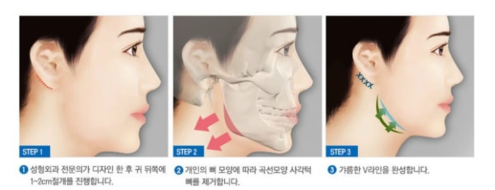 턱수술과 양악수술의 차이.gif | 인스티즈
