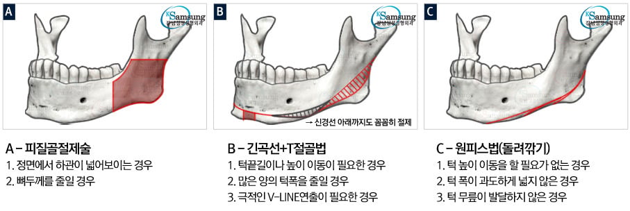 턱수술과 양악수술의 차이.gif | 인스티즈