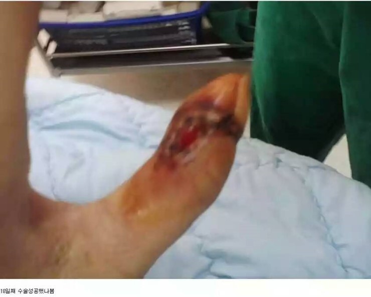 독사에물리면! [[]] | 인스티즈