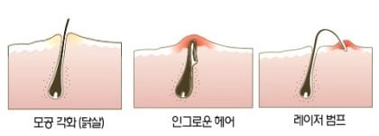 제모하는 여시들 짜증나는거 甲.jpg | 인스티즈