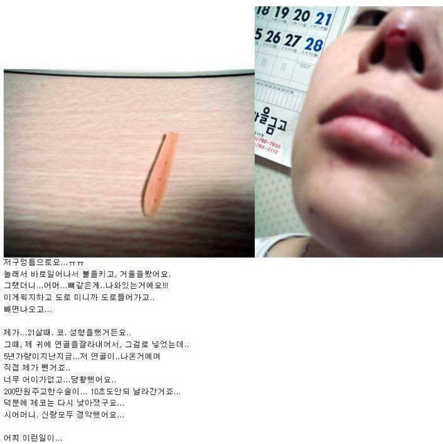 코수술 5년 후.... | 인스티즈