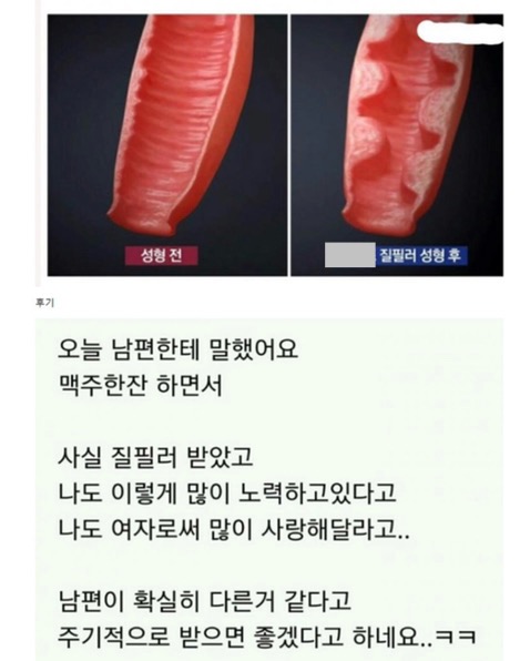 질 필러 시술 후기 | 인스티즈