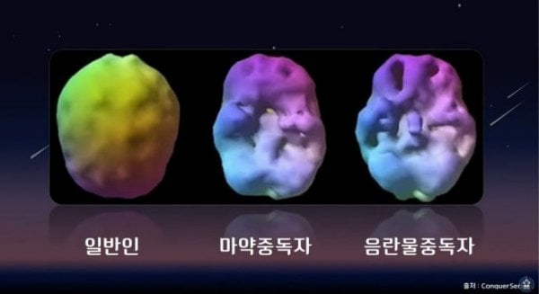 마약 중독자보다 더 심각하게 망가진 뇌 | 인스티즈