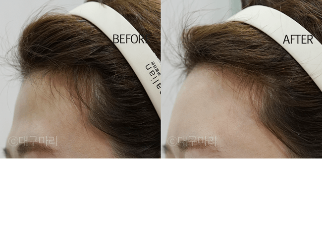 생각보다 많은 여자들이 컴플렉스로 꼽아서 성형 많이 하는 부위 | 인스티즈