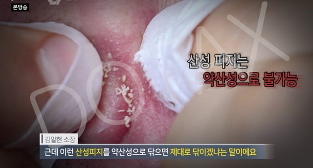 얼굴에 뭉치는 여드름 '산성피지'의 진실.jpg | 인스티즈
