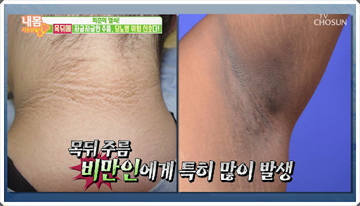 당뇨 걸리면 나타나는 증상들.jpg | 인스티즈