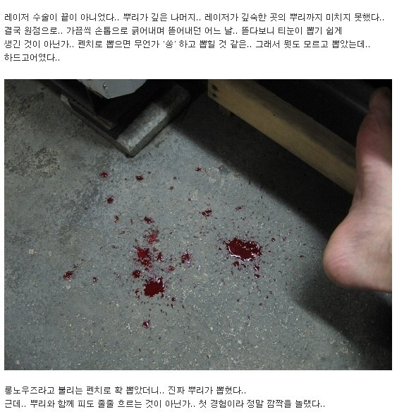 이쯤에서 생각나는 티눈뽑기 (혐오주의) | 인스티즈