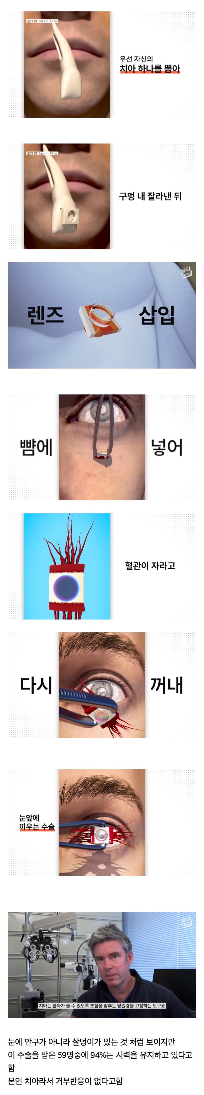 시각장애인의 눈에 치아를 넣어 시력을 회복하는 수술.jpg | 인스티즈