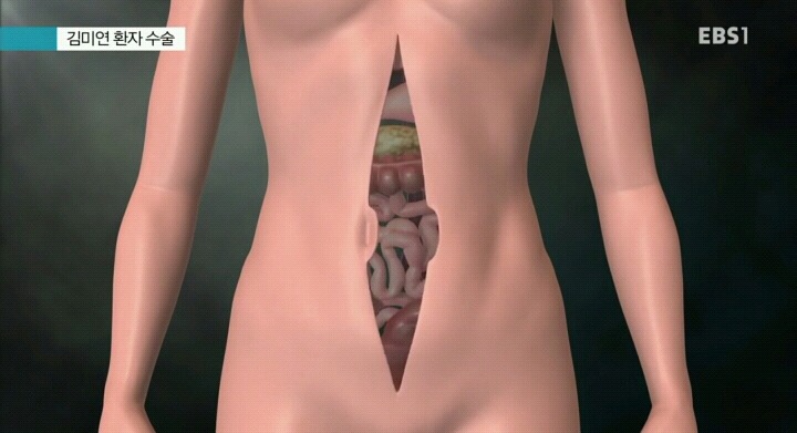 간까지 전이된 대장암환자 수술.jpg | 인스티즈