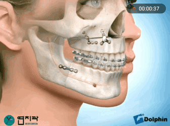 미용성형이 아닌데 한때 열풍처럼 유행했던 수술.gif | 인스티즈