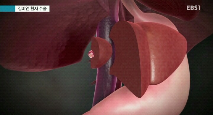 간까지 전이된 대장암환자 수술.jpg | 인스티즈