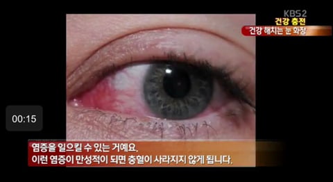 눈 안에 떠다니는 아이섀도 가루 사진.jpg | 인스티즈