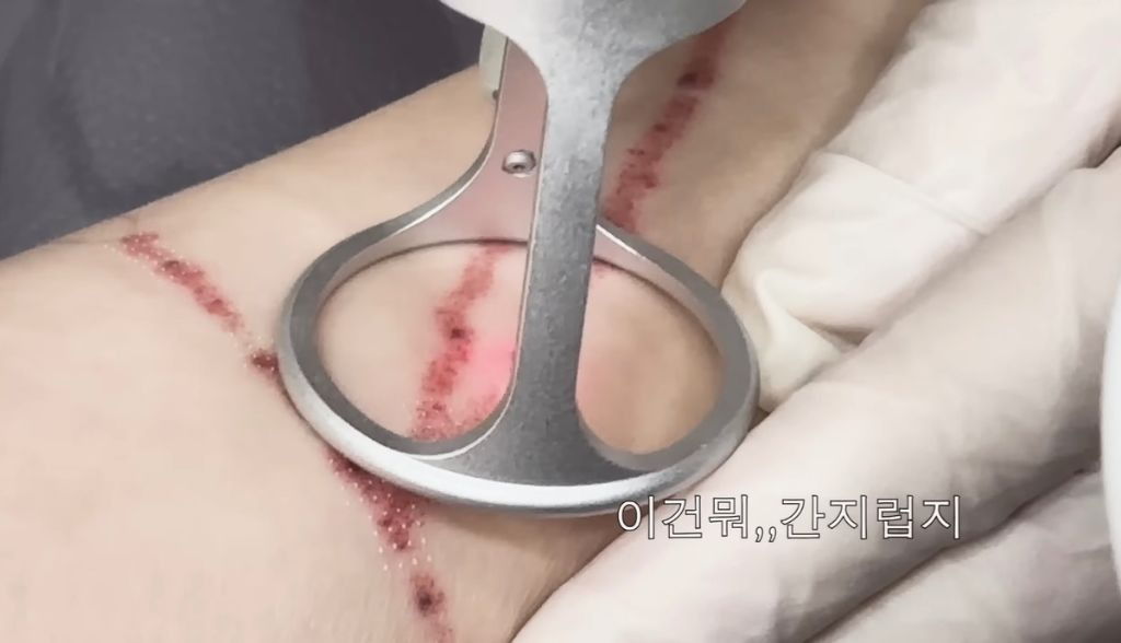 타투 제거 브이로그 올린 나나 | 인스티즈