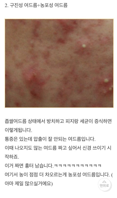  남자피부관리 온갖 여드름 종결 썰 | 인스티즈
