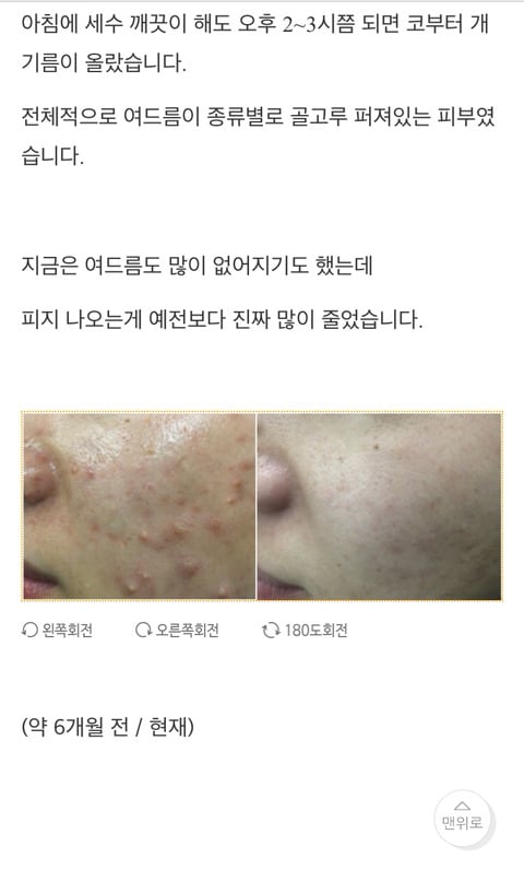  남자피부관리 온갖 여드름 종결 썰 | 인스티즈