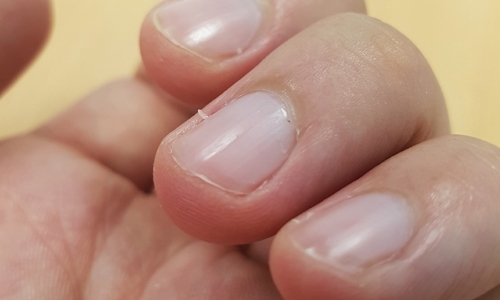 손톱 옆 일어난 살갗, 뜯어내면 안 되는 이유 | 인스티즈