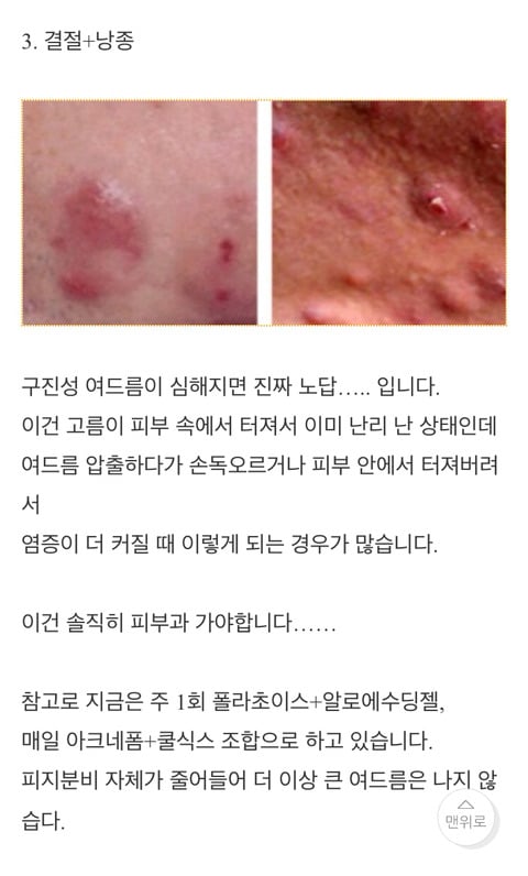  남자피부관리 온갖 여드름 종결 썰 | 인스티즈
