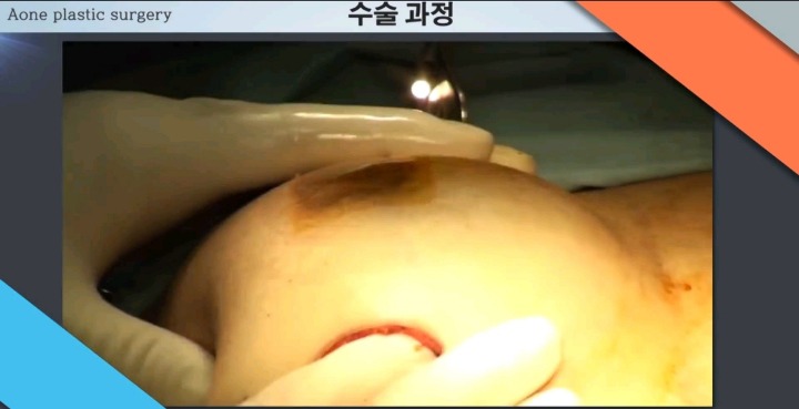 보형물 이용한 가슴성형.jpg (사진주의) | 인스티즈