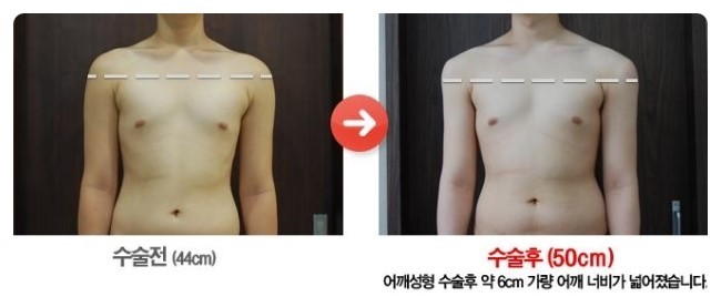 남자 어깨성형.jpg | 인스티즈