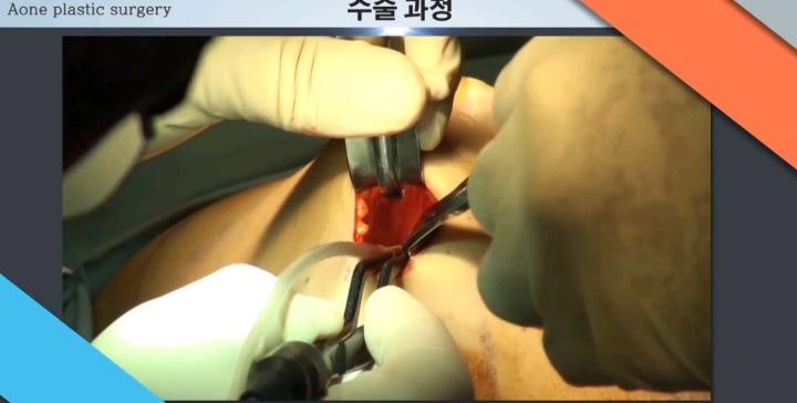 보형물 이용한 가슴성형.jpg (사진주의) | 인스티즈