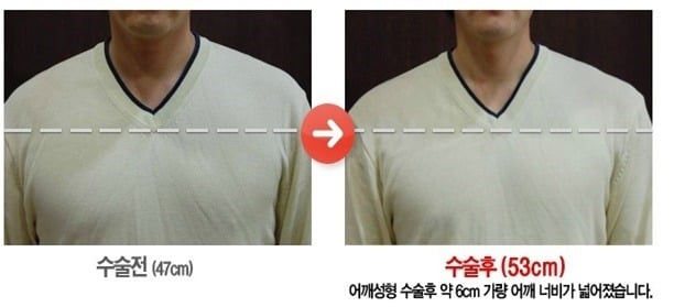 남자 어깨성형.jpg | 인스티즈
