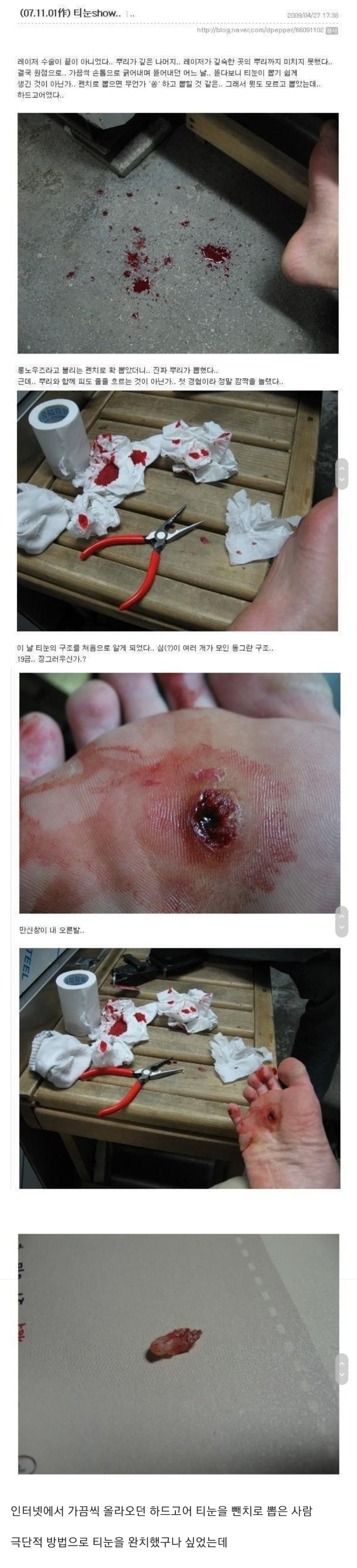 티눈을 뺀치로 뽑은 남자 근황 | 인스티즈