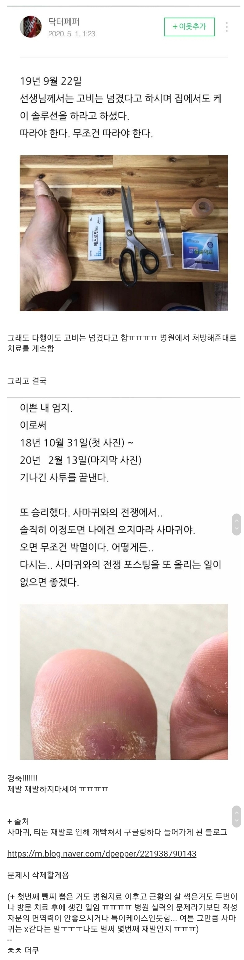 티눈을 뺀치로 뽑은 남자 근황 | 인스티즈