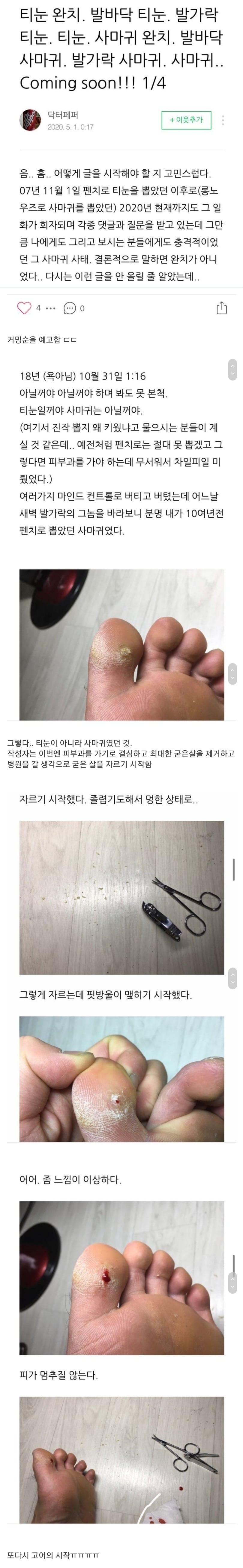 티눈을 뺀치로 뽑은 남자 근황 | 인스티즈