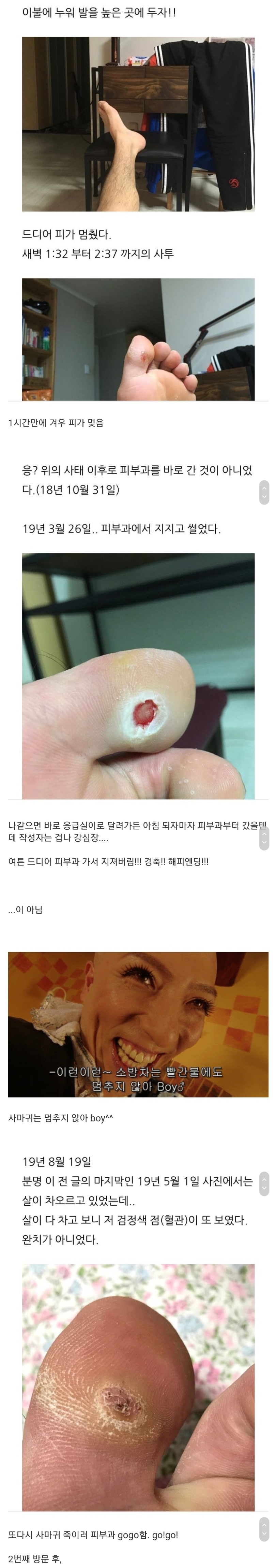 티눈을 뺀치로 뽑은 남자 근황 | 인스티즈