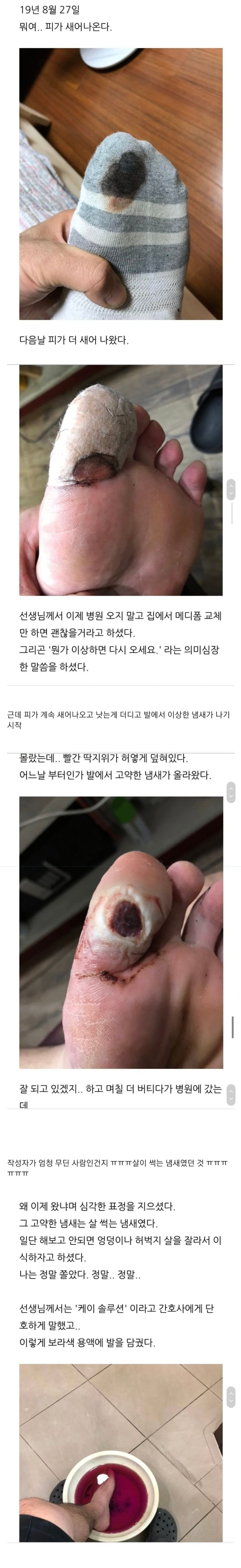 티눈을 뺀치로 뽑은 남자 근황 | 인스티즈