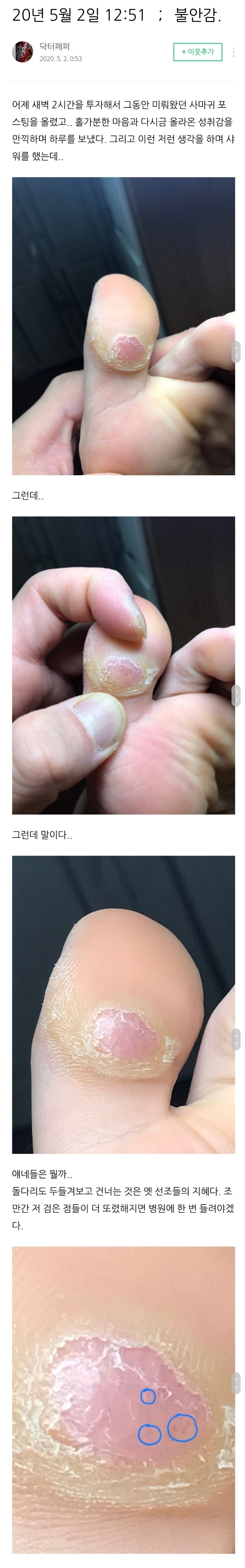 티눈을 뺀치로 뽑은 남자 근황 | 인스티즈