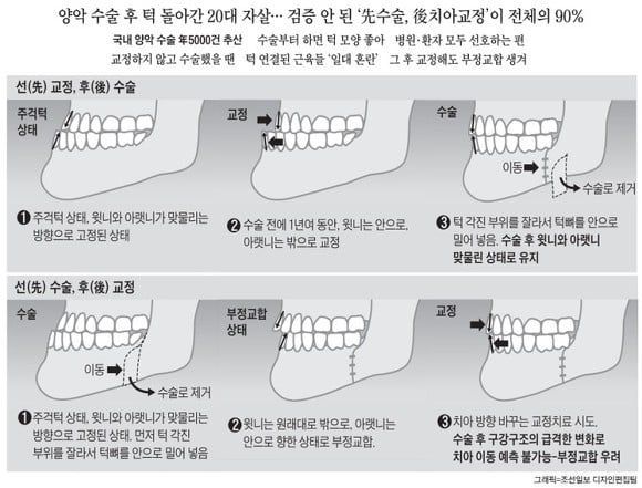 턱수술과 양악수술의 차이.gif | 인스티즈