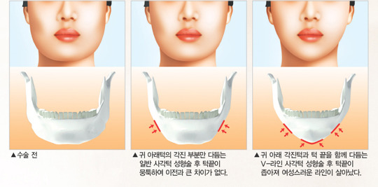 턱수술과 양악수술의 차이.gif | 인스티즈