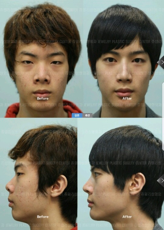 남자성형 전후 레전드 ㄷㄷ | 인스티즈