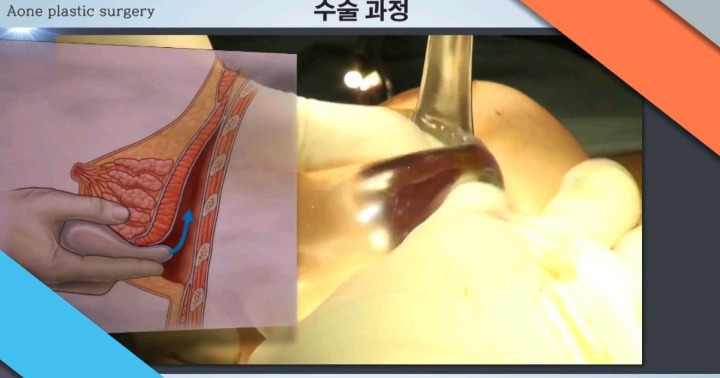 보형물 이용한 가슴성형.jpg (사진주의) | 인스티즈