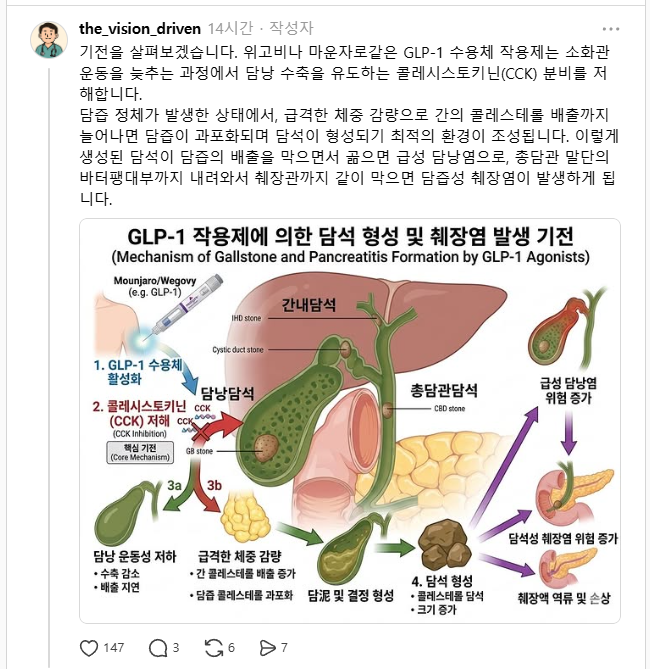 현직에서도 의견이 분분하다는 마운자로 관련 담낭염 | 인스티즈